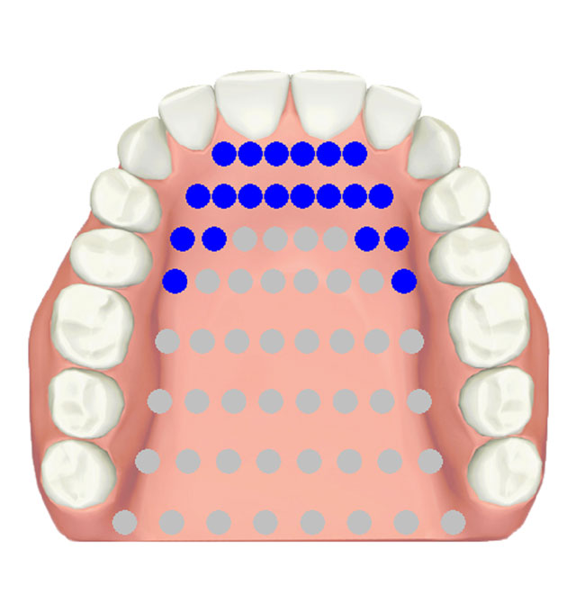 EPG apical /l/