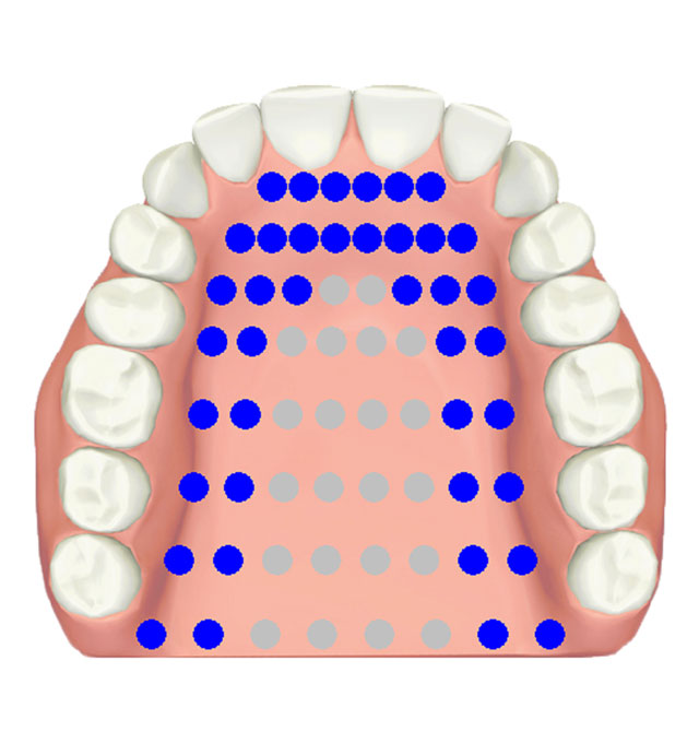 Electropalatography • alveolar stop /t/, /d/, /n/